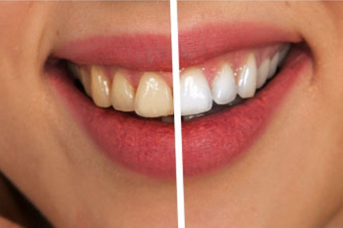 Bleaching/Prophylaxe